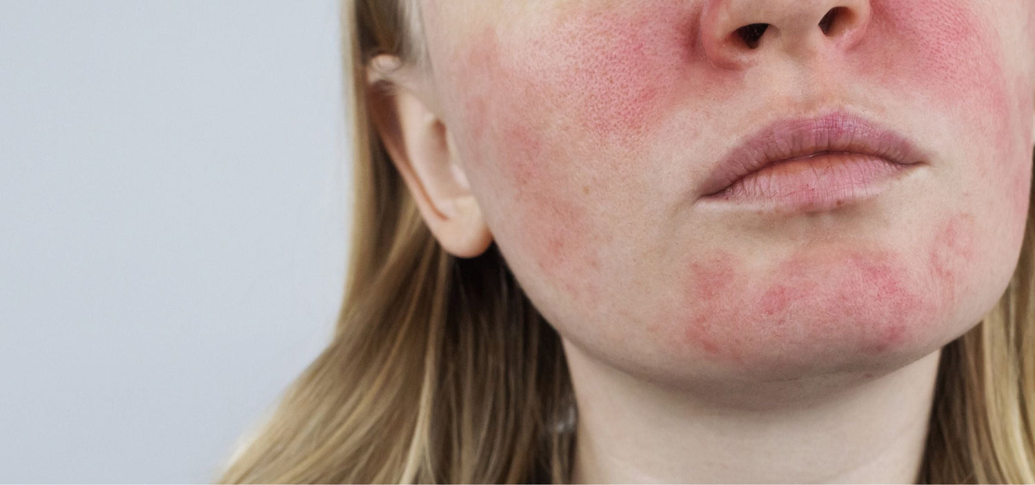 Couperose: Tipps für die richtige Pflege und Behandlung