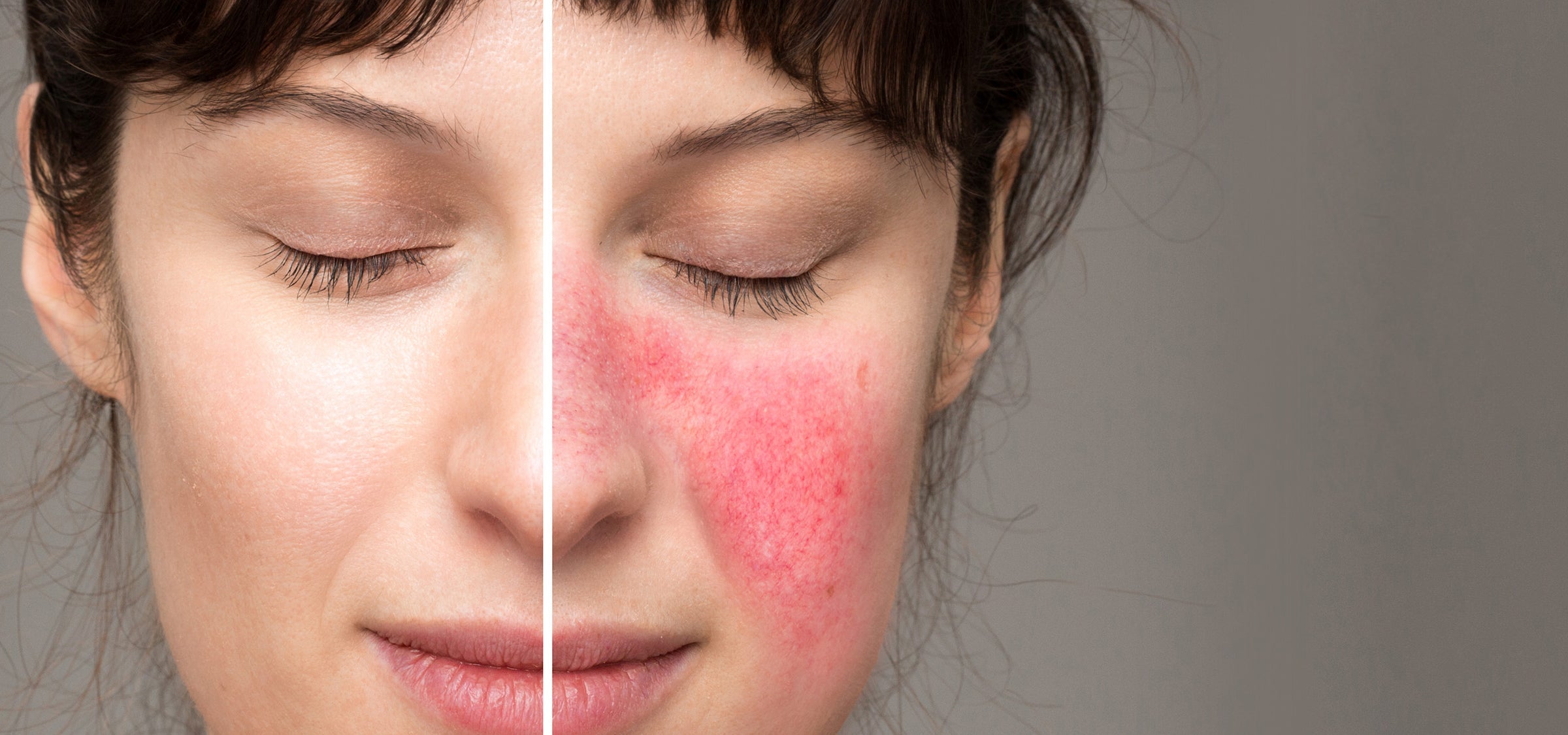 Typische Rötungen bei Rosacea auf der Wange einer Frau.